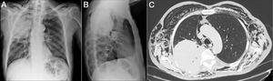 Pneumomediastinum and Massive Subcutaneous Emphysema Due to Lung ...