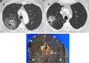 (A and B) Chest CT with IV contrast: lung window. Mass with central solid cavitary component (arrow) and extensive surrounding ground glass opacities. (C) Macroscopic specimen of lobectomy from case A, showing the central cavitary nodular lesion (star) surrounded by extensive perilesional hemorrhage (arrows) corresponding to the ground glass area on CT.
