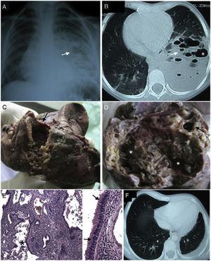 A) Anteroposterior chest X-ray shows right shift of the trachea and mediastinum, signs of air trapping, presence of a radiopaque image involving the left lower lobe, where multiple rounded radiolucent images (arrow), and left pleural effusion are seen. B) Chest CT shows solid-cystic lesion, without air bronchogram, with multiple cysts of variable size (arrow), from 5 to 15 mm, some converging to form larger cavities (asterisk). C and D) Gross examination found a specimen measuring 12 × 6 × 8 cm of friable tissue (arrow) with multiple cavities of varying size and purulent content (asterisk). E) Microscopy (H&E staining ×40) shows marked architectural alteration with multiple cystic formations (asterisks), the largest cystic formations (right, magnification ×100) being covered by a pseudostratified columnar epithelium (arrow) surrounded by thin fibromuscular walls and dense inflammatory infiltrate in the cystic and interstitial space, consistent with infected congenital cystic adenomatoid malformation type 2. F) Follow-up CT showing right and left upper lobe compensatory emphysema, and left posterior pleural and lateral thickening.