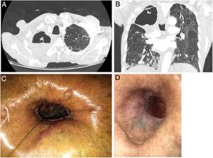Axial (A) and coronal (B) slices of the pulmonary cavity occupying practically the entire right upper lobe. Cavernostoma in the first few postoperative days (C). Cavernostoma after several months of topical treatment (D).