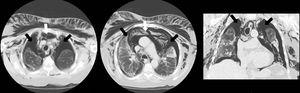 Chest CT: Bilateral pneumothorax (black arrows), predominantly left-sided, pneumomediastinum (white arrows) reaching the pericardium and diaphragmatic crura, and significant subcutaneous emphysema.