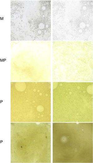 Murray scale to assess sputum color from lowest to highest purulence. M: mucoid; MP: mucopurulent; P: purulent.