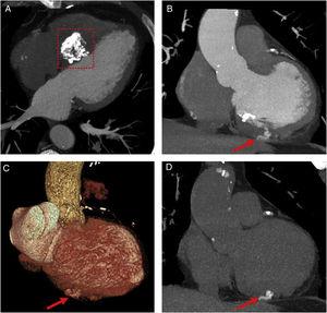 Contrast enhanced axial and coronal CT scans (A and B) and coronal 3D reformat CT angiography (C) show a calcified hydatid cyst (frame) in the interventricular septum and hyperdense lesion (arrows) in the left ventricular base. Non-contrast coronal CT scan (D) reveals a calcified hydatid cyst (arrow) in the left ventricular base.