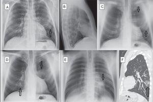 Bilateral COVID-19 pneumonia. A 52-year-old man, family doctor by profession, presented with a 10-day history of cough and myalgia. Dyspnea and fever on examination. Laboratory tests: normal white cell count, ferritin 545.7 ng/mL (>322), and erythrocyte sedimentation rate 53 m/n (0–20). PCR positive for SARS-CoV-2. A— Posterior-anterior chest X-ray: slight opacity in the periphery of the left hemitorax, middle field. B—Lateral chest X-ray with no obvious findings. C—DTS: Image no. 8 (anterior). Extensive opacity in anterior region of left hemitorax (arrows). D—DTS: Image no. 14 (central). Bilateral pulmonary opacities, in the left suprahilar region (arrow) and right lower lobe (arrow). E—DTS: Image no. 36 (posterior). Oval opacity in retro-cardiac region (arrow). F—Non-contrast chest CT scan, sagittal reconstruction. Oval opacity in the periphery of the left lower lobe (arrow).