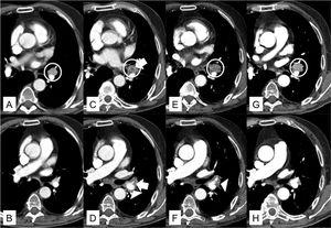 A: Chest CT scan in mediastinum window at the level of the bronchial bifurcation. Pathological lymphadenopathy with enhanced uptake is identified in the left hilum (white circumference). B: Chest CT scan in mediastinum window at the level of the right pulmonary artery. Patent lingular artery. C: Chest CT scan in mediastinal window at the level of the bronchial bifurcation, 34 days after A. The appearance of a hypodense focus (white arrow) in the center of the left hilar lymphadenopathy (white circumference) was observed. D: Chest CT scan in mediastinum window at level of the right pulmonary artery, 34 days after B. Appearance of a centrally located acute thrombus in the lingular artery (white arrow) and band of inflammation that encompasses the vascular structures of the left hilum (white arrowhead). E: Chest CT scan in mediastinal window at the level of the bronchial bifurcation, 44 days after A. Persistent left hilar lymphadenopathy and increased volume (white circumference) are observed. F: Chest CT scan in mediastinum window at level of the right pulmonary artery, 44 days after B. Resolution of acute thrombus located in the lingular artery but persistent band of inflammation surrounding the left hilar vessels (tip of white arrow). G: Chest CT scan in mediastinum window at the level of the bronchial bifurcation. Recovery of initial characteristics of left hilar lymphadenopathy, 69 days after A. H: Chest CT scan in mediastinum window at the level of the right pulmonary artery, 69 days after B. Resolution of band of inflammation that surrounded the left hilar vessels.
