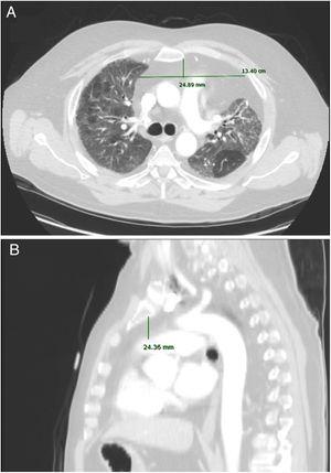 Preoperative radiological measurements on chest CT scan, in a patient with high AMF volume. (A) Anteroposterior and transverse axes. (B) Height.