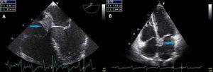 Transthoracic echocardiogram (A) and transesophageal echocardiogram (B) showing echogenic mass (arrows) located in the interatrial septum.
