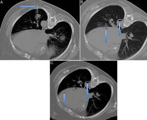 Axial CT slices for performing lung biopsy with the patient positioned in the right lateral decubitus position. A) The upper left image shows the Tru-Cut needle entering the lesion located in the lower left lobe (arrow). B) The upper right image shows the presence of air within the descending aorta artery and the circumflex artery (arrows). C) The lower image shows the presence of air inside the left ventricle (arrow).