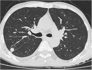 Axial thoracic CT scan with lung parenchyma window of a 63-year-old male patient, showing a solitary fissure-attached pulmonary nodule in the posterior segment of the upper lobe of the right lung. The patient has been followed for 7 years due to PAE.