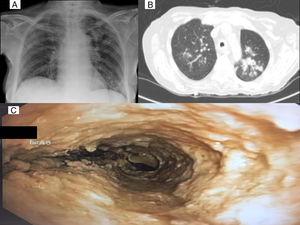 A) Chest X-ray: parenchymal infiltrates in left upper lobe and left lower lobe. B) Chest CT: infiltrates in both upper lobes, predominantly in LUL. C) Endoscopy: Aspergillus pseudomembranous tracheobronchitis.