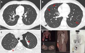 Chest computed tomography. A) Lung cyst measuring 16 mm in diameter with thin smooth walls, showing a ground glass halo in the right lower lobe (arrow). B) Multiple lung cysts with bilateral distribution (arrows), one with a ground glass halo (arrow with asterisk). C) Left pneumothorax and fibrous tracts in the vertices (arrow). D) Flat hypermetabolic lesion measuring 4 × 1.9 cm (SUV 5.3) in the right vastus lateralis muscle (arrows), associated with hypermetabolic inguinal lymphadenopathies in the same side.