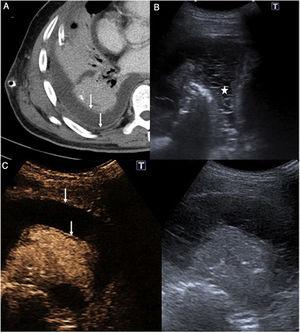 (A–C) Bacterial pleural empyema. (A) CT axial image showing pleural effusion with thickening and hyperenhancement of pleural layers (white arrows) consistent with the split pleura sign. (B) Chest ultrasound showing multiple echoes and septa in pleural fluid, with no obvious loculations (asterisk), findings not visible on previous CT. (C) Chest contrast-enhanced ultrasound. The image on the left shows the contrast-enhanced ultrasound scan, 70 s after administration, and the image on the right shows the standard procedure. The contrast-enhanced image shows thickening and hyperenhancement of the parietal and visceral pleural layers (white arrows), that can be superimposed on those seen in Figure A.