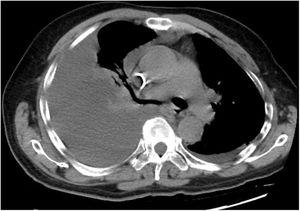 Computed tomography of the chest revealed Large right pleural effusion nearly fills the right thoracic cavity.