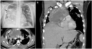 (A) Thoracic X-ray showing a heterogenous right-sided mass continuous to the mediastinum (black arrow) and multiple pulmonary well-defined opacities (white arrows); (B) Coronal section on thoracic CT-scan showing a heterogeneous solid mediastinal mass (black arrow), touching the right atrium and diaphragm, and two pulmonary solid nodules on the left lung (white arrows); (C) Axial section on thoracic CT-scan presenting the anterior mediastinal mass (black arrow) contacting the ascending aorta, and left and right pulmonary nodules suggesting various metastasis (white arrows).