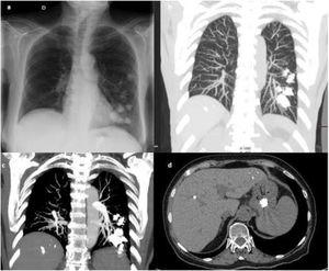 (a) PA chest X-ray. Multiple high-density nodular opacities in middle and lower left fields and in the epigastrium. (b) Contrast-enhanced CT chest with MIP reconstruction. Hyperdense extravascular embolization material in the middle and lower left field. (c) Contrast-enhanced CT chest with MIP reconstruction. Bilateral hyperdense embolization material in the left lower lobe, larger than the pulmonary vessels. (D) Embolization material inside the stomach.