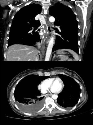Extensive azygos and hemiazygos vein repletion defects, with no signs of thrombosis in main, lobar, or segmental pulmonary arteries.
