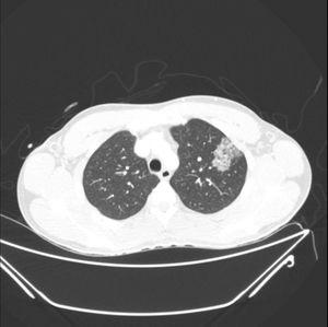 CT scan showing infiltrate in the left upper lobe.
