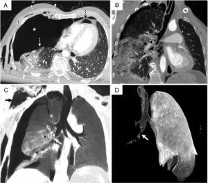 Chest CT with intravenous contrast agent: (A) Axial plane, lung window. Fallen lung sign (dashed white arrow) due to collapse and displacement of the pulmonary hilum toward the lower segments. Right tension pneumothorax (white asterisk) is also observed, causing contralateral mediastinal displacement and pneumopericardium (dashed black arrow). (B) Coronal reconstruction, lung window. Pneumomediastinum with air surrounding the bronchi and pulmonary vessels lying in parallel to bronchi in the pulmonary hilum (black arrowhead). (C) Multiplanar reconstruction with minimum intensity projection, coronal plane, lung window showing subcutaneous emphysema (solid black arrow) and airway discontinuity (white arrow). (D) Three-D volume rendering, anteroposterior projection with suppression of right lung. Laceration of the intermediate bronchus with bronchial amputation and discontinuity of the airway (white arrow).