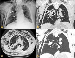 Chest X-ray, PA projection (A). Extensive subcutaneous emphysema in right chest wall and supraclavicular and cervical region, along with pneumomediastinum (arrows). Poorly delimited mass in the right upper lobe (asterisk), apparently communicating with a bronchus leading to that lobe (arrowheads). Chest CT without intravenous contrast medium, pulmonary parenchyma window. Multiplanar reconstructions in coronal (B) and axial (C) planes, with minimum intensity projection (D). The air cavity is clearly seen surrounding the treated mass (arrowheads in B and C), communicating with a bronchial branch to that lobe (arrowheads in D), along with pneumomediastinum (white arrows) and extensive subcutaneous emphysema predominantly in the right chest wall. Note the large gas-filled space in the chest wall adjacent to the post-thermal ablation cavity, suggesting communication between the two cavities (C and D asterisk). There are also signs of centrilobular emphysema predominantly in the upper lobes.