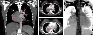 Coronal (A) and axial (B) CT scans show a giant pulmonary sequestration (star) feeding by systemic arteries (red arrows). Maximum intensity projection (MIP) axial CT scan (C) also reveals that the pulmonary sequestration was drained by the pulmonary vein (blue arrow) of the right lower lobe. Coronal volume rendering negative MIP image shows clearly the drainage vein (blue arrow). RPA, right main pulmonary artery; RPV, right main pulmonary vein.