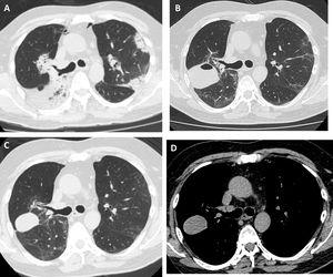 High-resolution chest tomography. (A) before TBCB: bilateral consolidations with peripheral and peribronchovascular air bronchogram. (B) 1 month after TBCB: lesion with air-fluid level in right upper lobe. (C) and (D) 3 months after TBCB: decrease in the size of the lesion with disappearance or reabsorption of the air content and persistence of the bloody content (hematocele).
