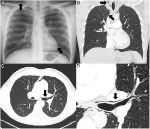 (A) Plain chest X-ray in posteroanterior projection showing pneumomediastinum and subcutaneous emphysema (arrows). (B) Coronal reconstruction of the chest CT scan (lung window) confirming the presence of pneumomediastinum and subcutaneous emphysema (arrows). (C) Axial image of the chest CT (lung window) showing left peribronchial emphysema with pneumomediastinum (arrow) – the Macklin effect. (D) Enlarged image of peribronchial emphysema (arrow).