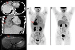 Chest-abdomen-pelvis computed tomography with intravenous contrast in axial (A) and coronal (B) planes, showing the anterior mediastinal mass with heterogeneous enhancement and an infiltrative appearance (red arrows). T2-weighted MRI image with fat suppression (C) identifying the hyperintense anterior mediastinal mass (red arrow). The lesion was markedly hypermetabolic on the initial PET/CT images (SUVmax = 11.9) (D) and disappeared on PET/CT after 4 months of treatment (E).