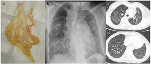 (a) Bronchial mold expected by the patient. (b) Posterior-anterior chest X-ray showing multilobar infiltrates in both lung fields. (c) Thoracic computed tomography showing multiple parenchymal opacities in tarnished glass with geographic distribution in both lung fields. (d) Chest computed tomography with smooth thickening of the interlobular septa in both lower lobes that in a patient with Noonan syndrome suggest the presence of lymphatic dysplasia.