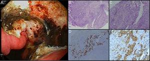 (A) On the posterior side of the gastric lower body, a deep ulcer with elevated edges was observed, with an extension of about 5cm – biopsies of the edges were performed. (B) and (C) Hematoxylin-and-eosin staining of the gastric lesion showed a papillary pattern and cohesive neoplastic cells forming irregular gland-like tubular structures, findings compatible with poorly differentiated adenocarcinoma. The positivity of (D) thyroid transcription factor 1 (TTF-1) and (E) cytokeratin 7 (CK-7) stained in brown was determined by immunohistochemistry.