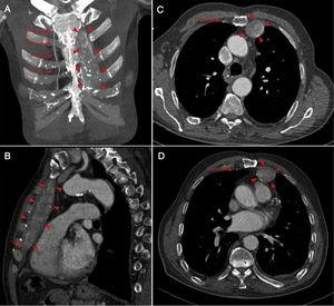Coronal maximum intensity projection (A), sagittal (B), and consecutive axial (C and D) CT scans in mediastinal window show a thrombosed giant left internal mammary artery aneurysm aneurysm (arrow heads). The right internal mammary artery seen as normal (arrows).