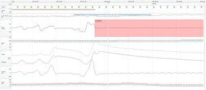 Recording of the cardiorespiratory sleep study showing a long apnea period with synchronous groan sound (Catathrenia).