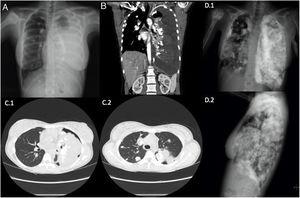 Plain PA chest X-ray (A) and chest-abdominal CT coronal slice (B) at diagnosis, showing massive left pleural effusion, right humeral head blastic lesion, and multiple calcium density images in bilateral pulmonary parenchyma and pleura. Chest CT axial slice (C1 and C2) after drainage of pleural effusion, significant for multiple bilateral metastases in lung parenchyma and pleura, and left pneumothorax. Plain PA and lateral chest X-rays (D.1 and D.2) at 10 months after diagnosis, showing an increase in the number and size of bilateral pulmonary and pleural nodules and masses, left pleural effusion, and an increase in the size of the primary lesion in the right humeral head.