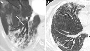 (A) Radiological bronchiectasis (white arrows) in the acute infectious disease (pneumonia) and, (B) radiological bronchiectasis in the fibrotic phase of the infection (free access from Refs. 5 and 6).