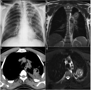 (a) Chest X ray PA view showing an ill-defined radiopacity in left upper lung field. (b) T2 weighted imagines haste coronal view hyperintense lesion was observed. There was band formation compatible with germinative membrane in the lesion. (c) Positron emission tomography (PET)/computed tomography (CT) showed hypometabolic cavitary lesion was observed in the left lung upper lobe. (d) T2 weighted imagines haste axial view hyperintense lesion was observed. There was band formation compatible with germinative membrane in the lesion.