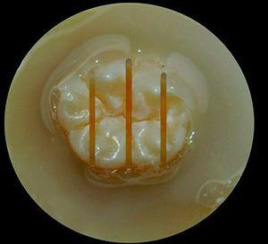 Cortes sagitais ao nível coronal, com o intuito de obter duas fatias de dentina com uma espessura de 3mm.