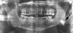 Dental panoramic tomography showing a radiopaque well-defined image at the left mandibular angle.