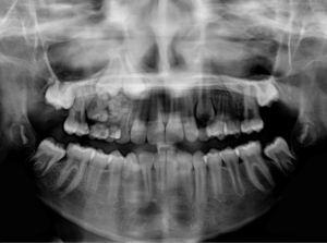 Panoramic radiography showing multiple radio opaque tooth-like structures in the apical area of teeth 53 and 54.
