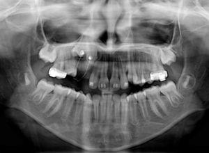 One month pos-treatment panoramic radiograph.