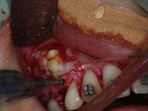 Removal of bone overlying the odontoma.