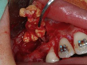 Surgical removal of odontoma along with its fibrous capsule.