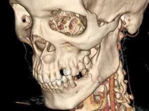 Tomografia computadorizada, reconstrução tridimensional (Figuras 4, 5 e 6 evidenciam lesão de tecido mole associada a depressão na cortical óssea vestibular da pré‐maxila, lado esquerdo).
