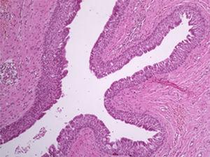 Corte histológico num aumento de 100x, corado com HE. Cavidade cística revestida por epitélio pseudoestratificado com células cilíndricas e presença de cílios em algumas regiões.