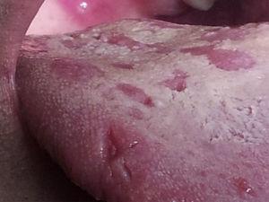 Máculas sifilíticas e ulcerações superficiais (palato e língua).