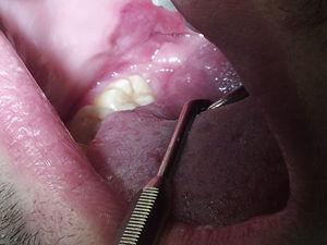 Máculas sifilíticas e ulcerações superficiais (mucosa oral direita).