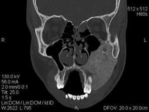Preoperative CT scans, coronal view of first case.