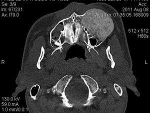 Preoperative CT scans, axial view of first case.