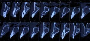 Computerized axial tomography-sagittal slices.