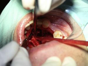 Intra-oral photograph-exeresis of the cyst.