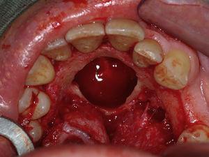 Intra-oral photograph after cyst removal.