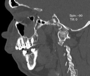 TC: vista sagital que muestra el desplazamiento inferior del suelo orbitario.